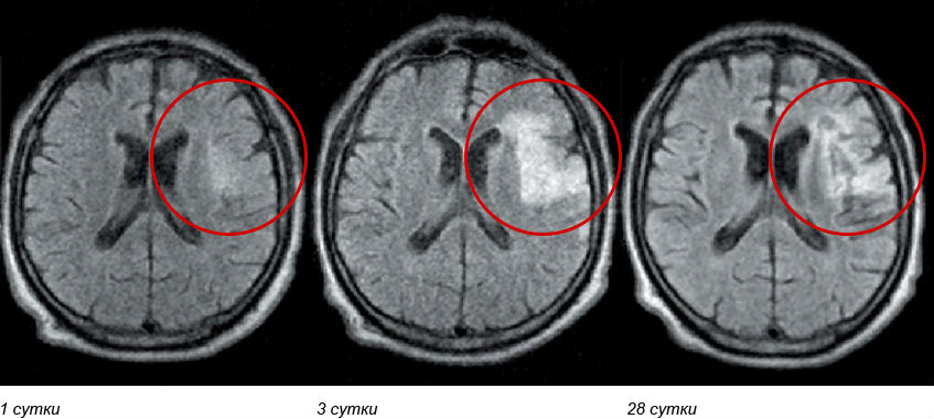 МРТ диагностика и лечение инсульта MRI MRT